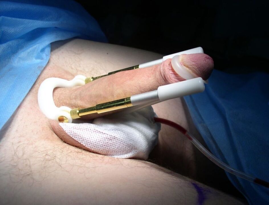 Verwendung eines Extenders nach der Operation
