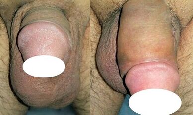 Foto vor und nach der Erhöhung des Penis