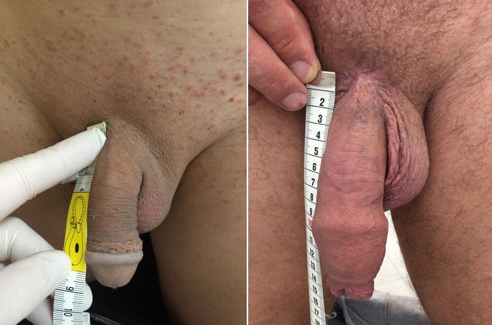 vor und nach operativer Penisvergrößerung